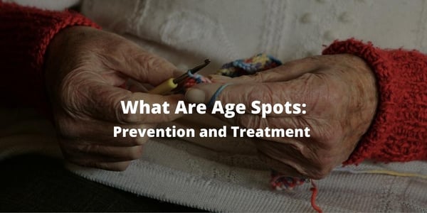 What Are Age Spots: Prevention and Treatment